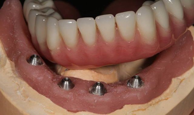 Partial Dentures Before And After Welaka FL 32193